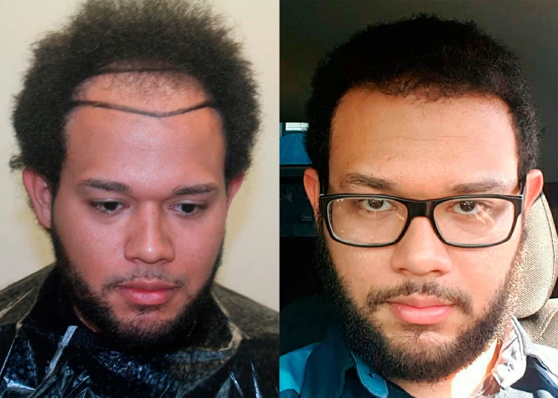 Patient 378 Hair Transplant Before and After