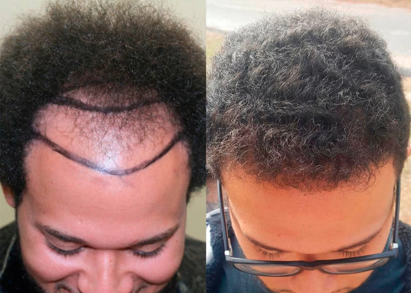 Patient p378 hair transplant before and after tilt view