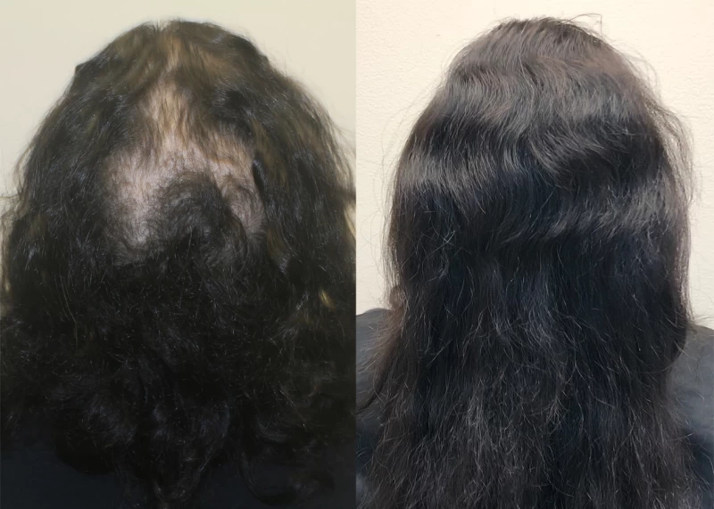 Patient p379 hair transplant before and after crown view