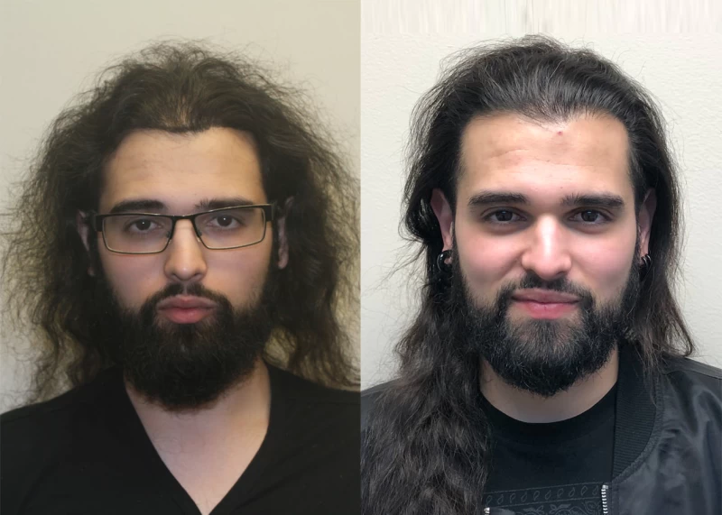 Samim Hair Transplant Before and After