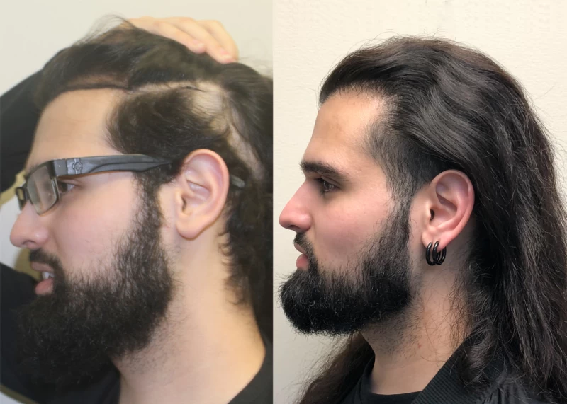 Patient p379 hair transplant before and after left view