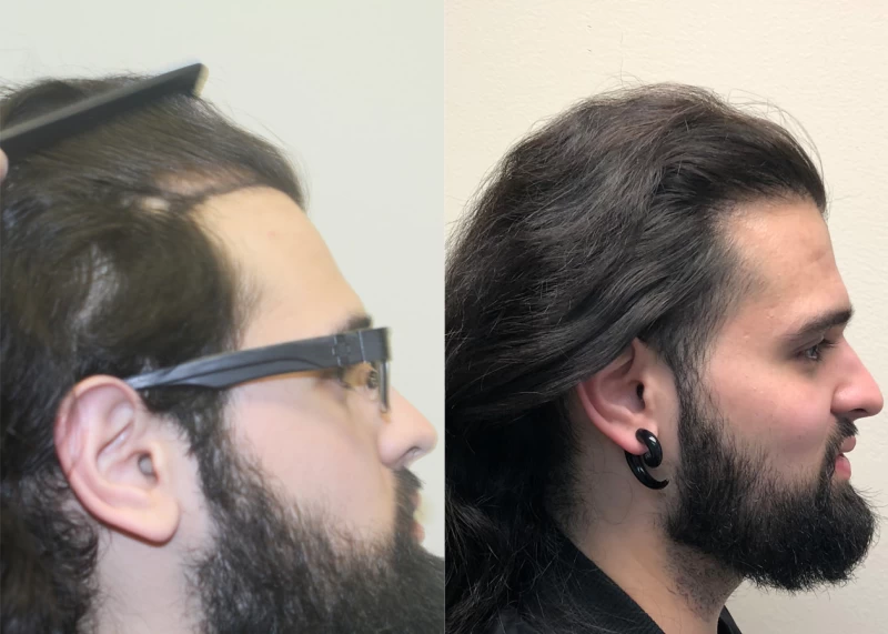 Patient p379 hair transplant before and after right view