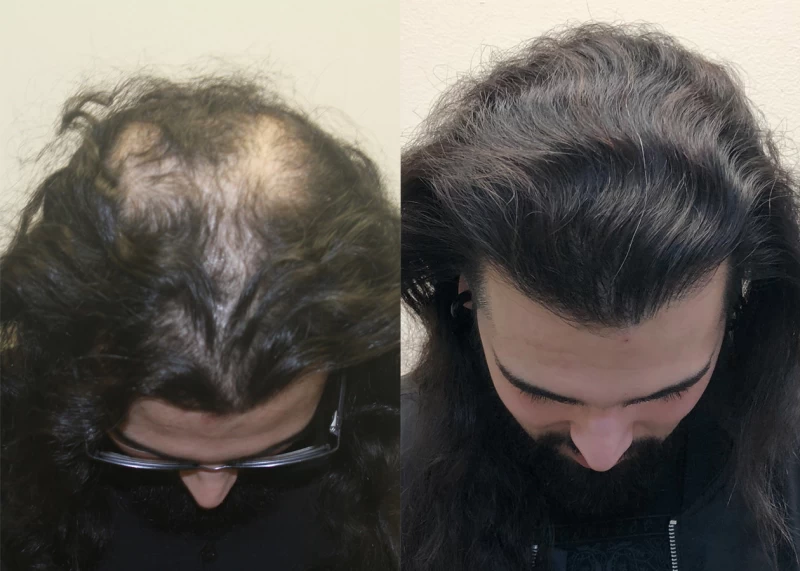 Patient p379 hair transplant before and after tilt view