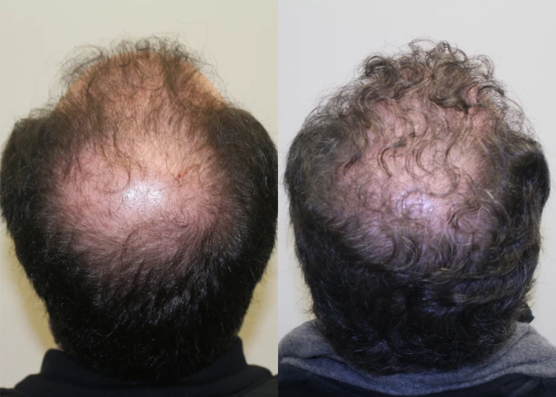 Patient p380 hair transplant before and after crown view
