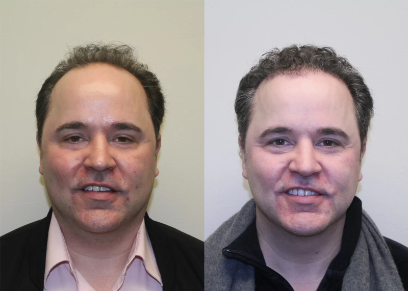 Patient 380 Hair Transplant Before and After