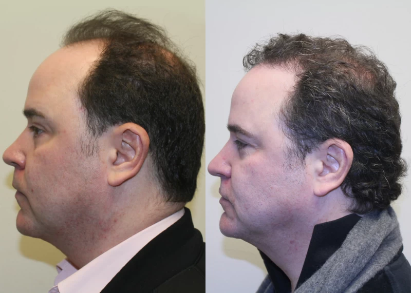 Patient p380 hair transplant before and after left view