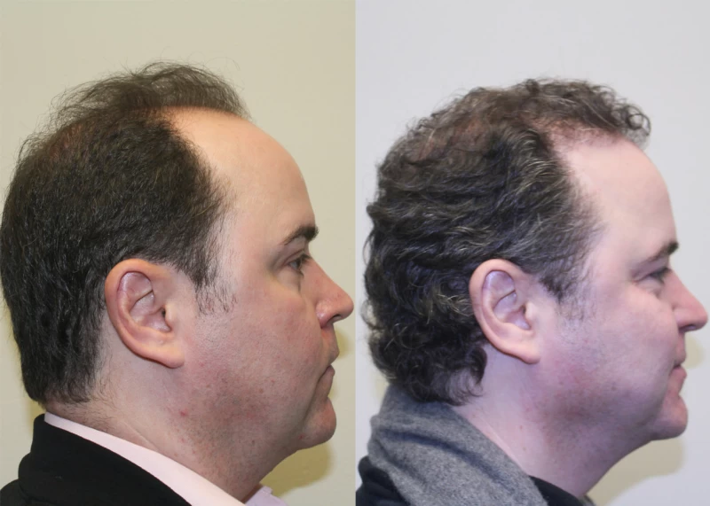 Patient p380 hair transplant before and after right view