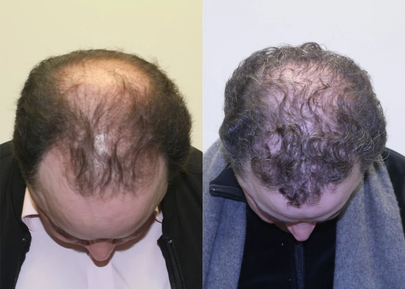 Patient p380 hair transplant before and after tilt view