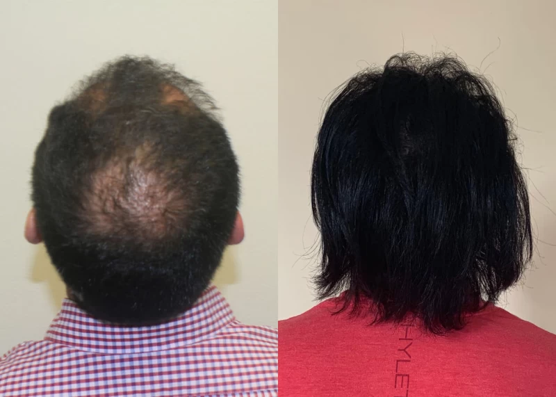 Patient p381 hair transplant before and after crown view