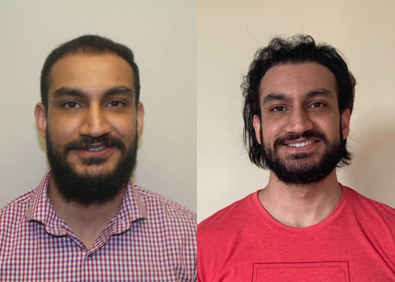 Mehtab Hair Transplant Before and After