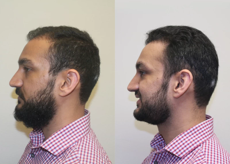 Patient p381 hair transplant before and after left view
