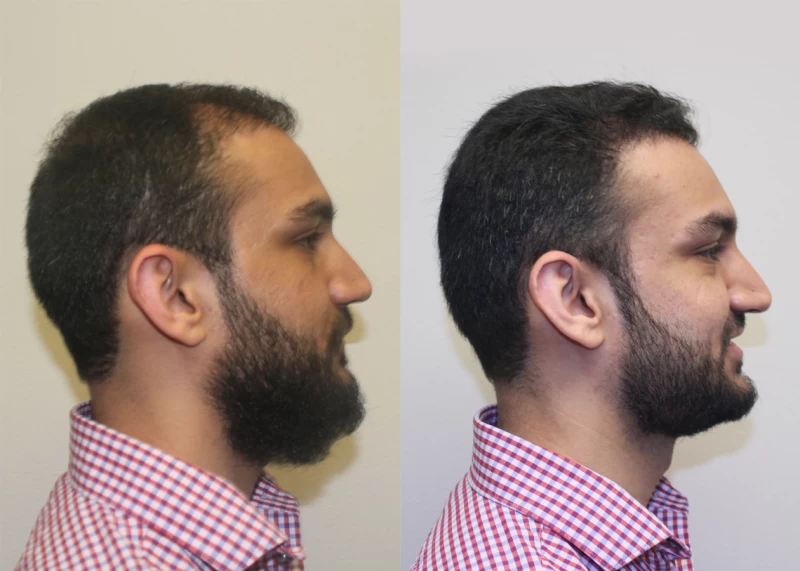 Patient p381 hair transplant before and after right view