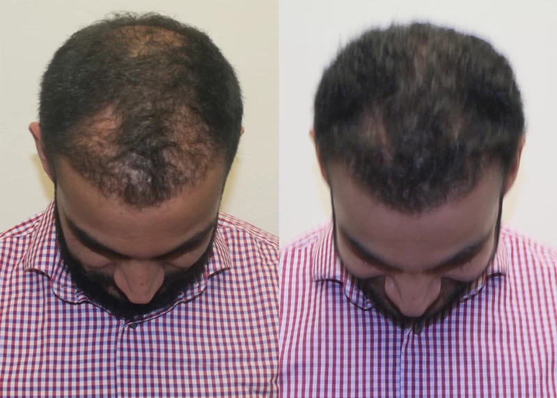 Patient p381 hair transplant before and after tilt view