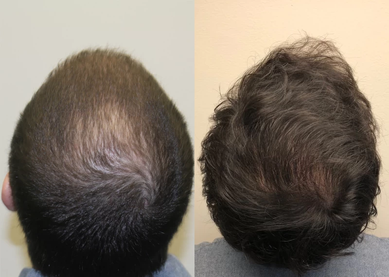 Patient p382 hair transplant before and after crown view