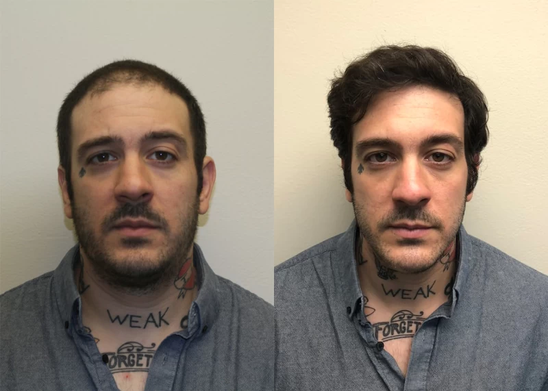 Marc  Hair Transplant Before and After