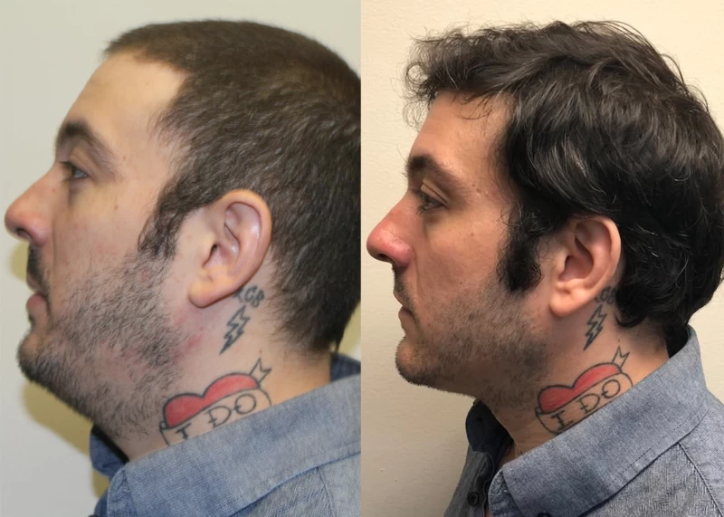 Patient p382 hair transplant before and after left view