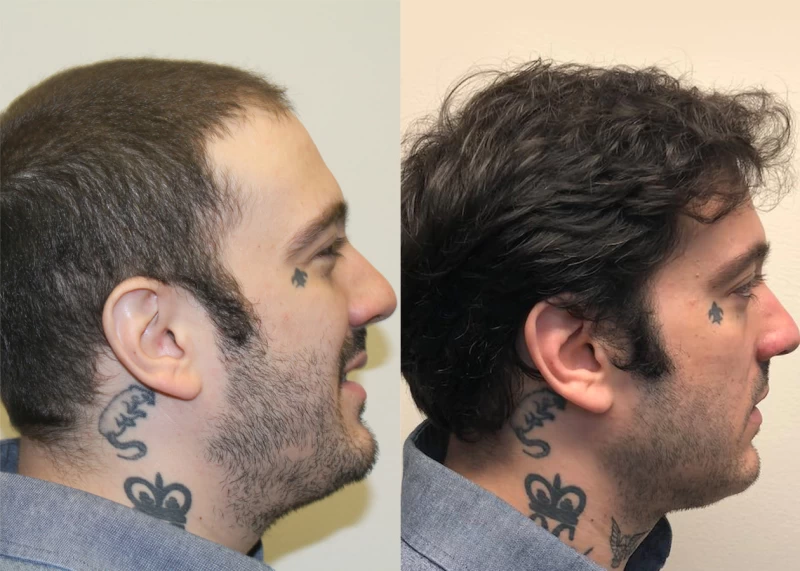 Patient p382 hair transplant before and after right view