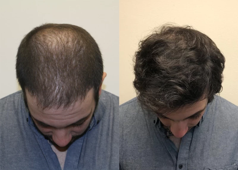 Patient p382 hair transplant before and after tilt view