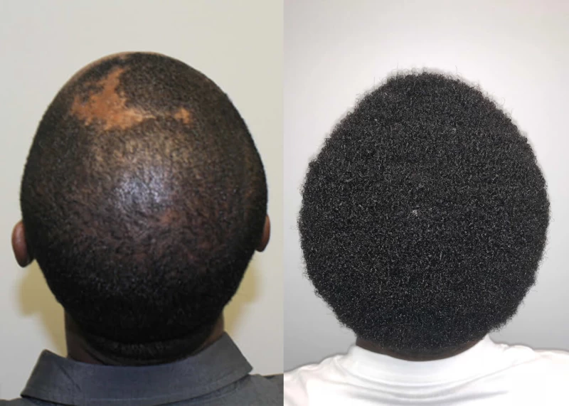 Ron burn patient hair transplant before and after crown view