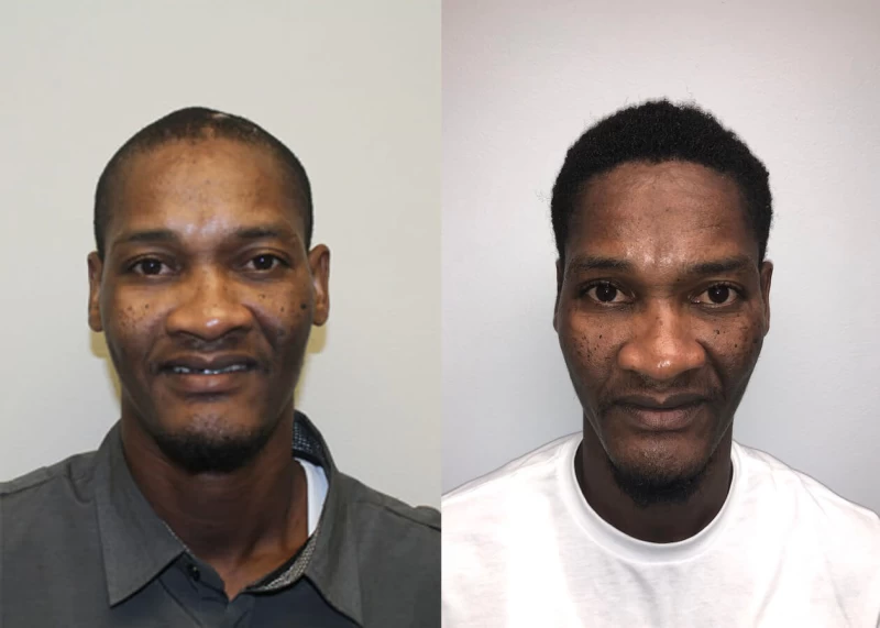 Ron burn patient hair transplant before and after front view