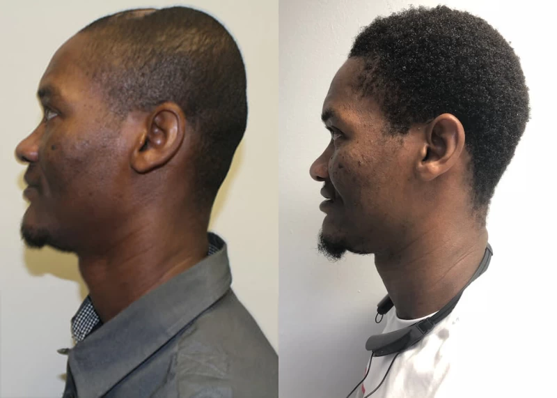 Patient p383 hair transplant before and after left view