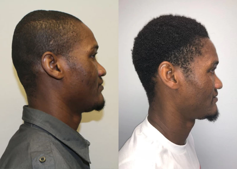 Patient p383 hair transplant before and after right view