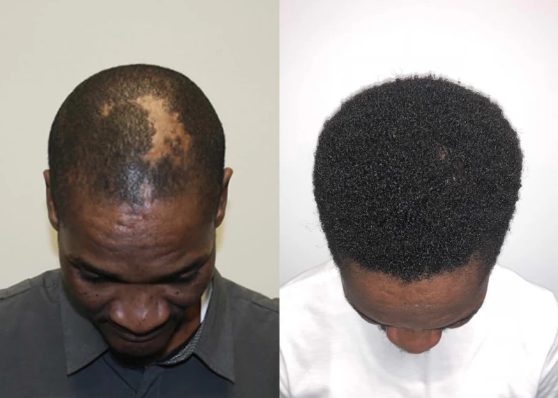 Patient p383 hair transplant before and after tilt view