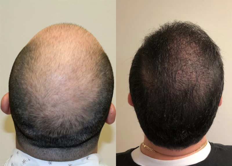 Patient p384 hair transplant before and after crown view