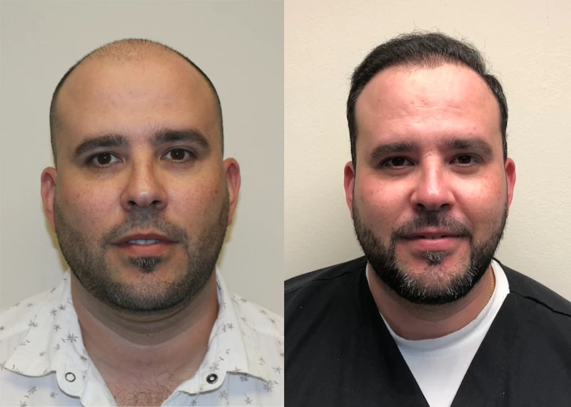 Adrien Hair Transplant Before and After