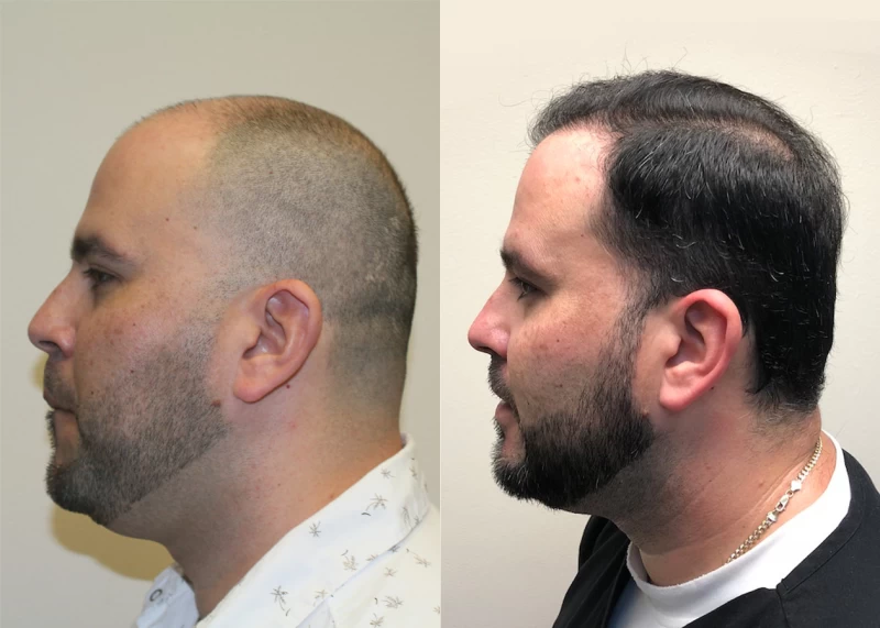 Patient p384 hair transplant before and after left view