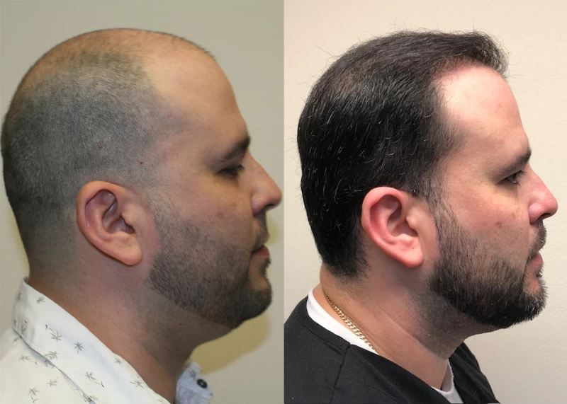 Patient p384 hair transplant before and after right view
