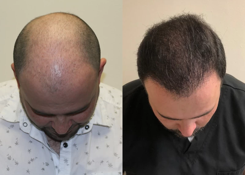 Patient p384 hair transplant before and after tilt view