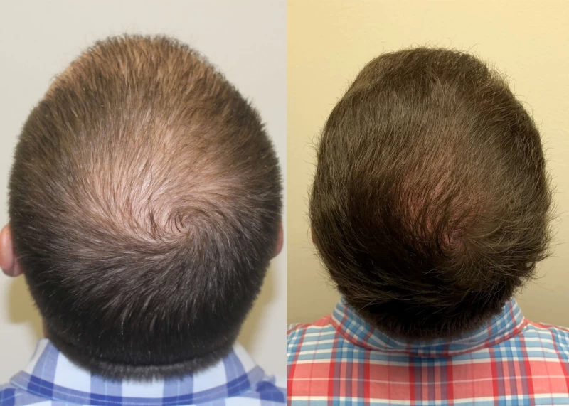 Patient p385 hair transplant before and after crown view
