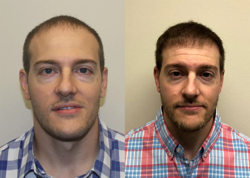 Joel Hair Transplant Before and After