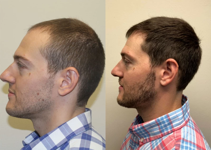 Patient p385 hair transplant before and after left view