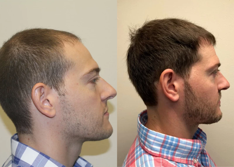 Patient p385 hair transplant before and after right view