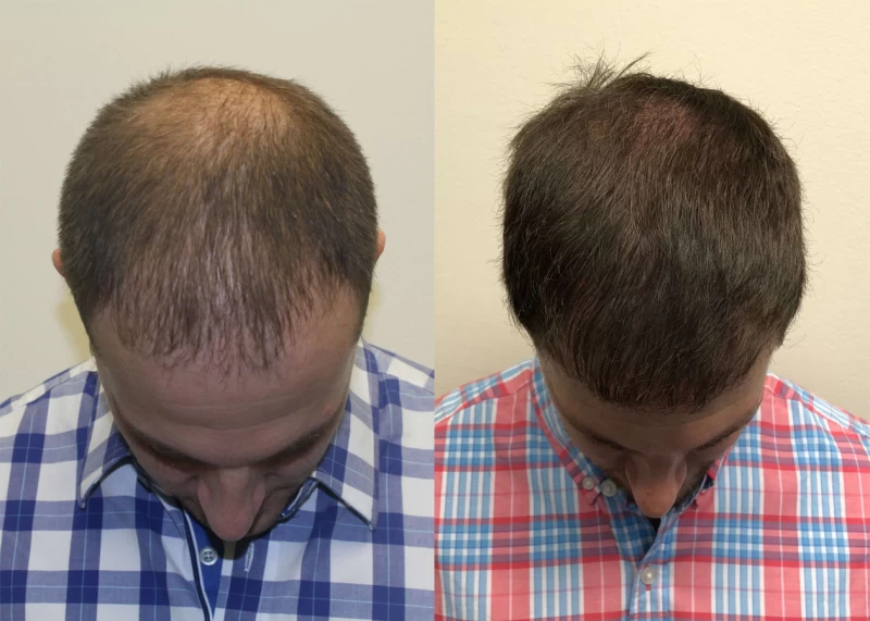 Patient p385 hair transplant before and after tilt view