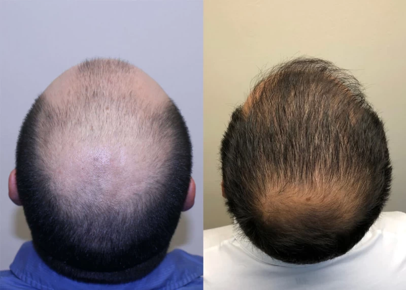 Patient p386 hair transplant before and after crown view