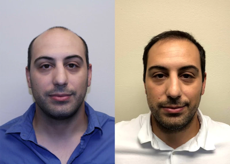 Jose Hair Transplant Before and After
