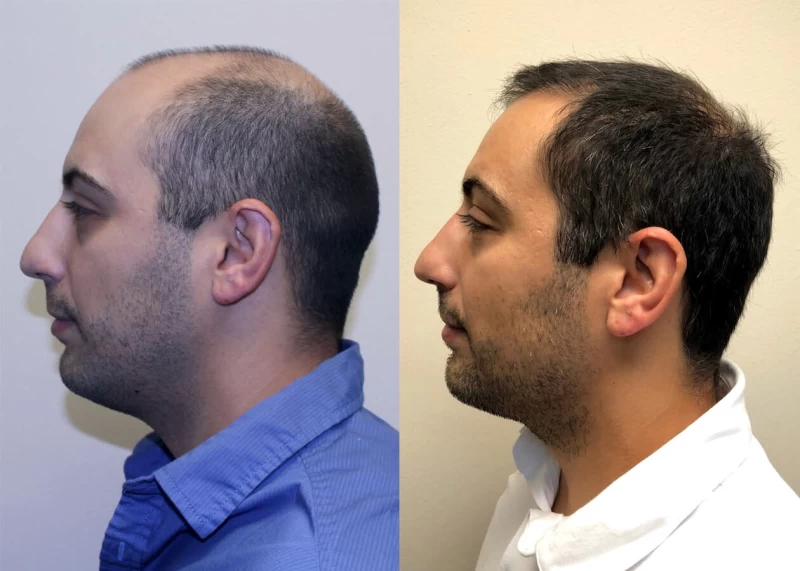 Patient p386 hair transplant before and after left view