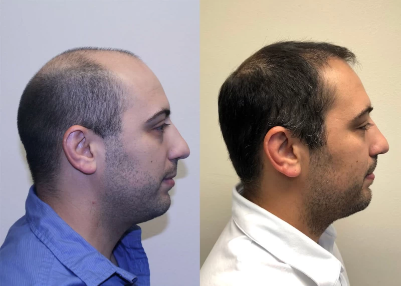 Patient p386 hair transplant before and after right view