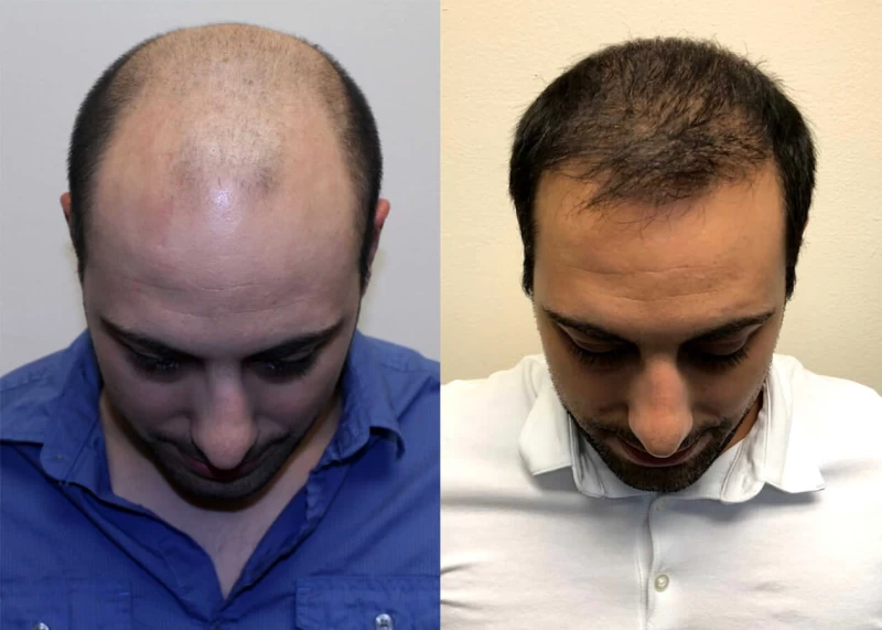 Patient p386 hair transplant before and after tilt view