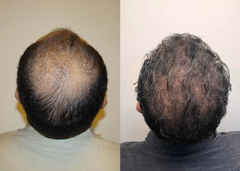 Patient p387 hair transplant before and after crown view