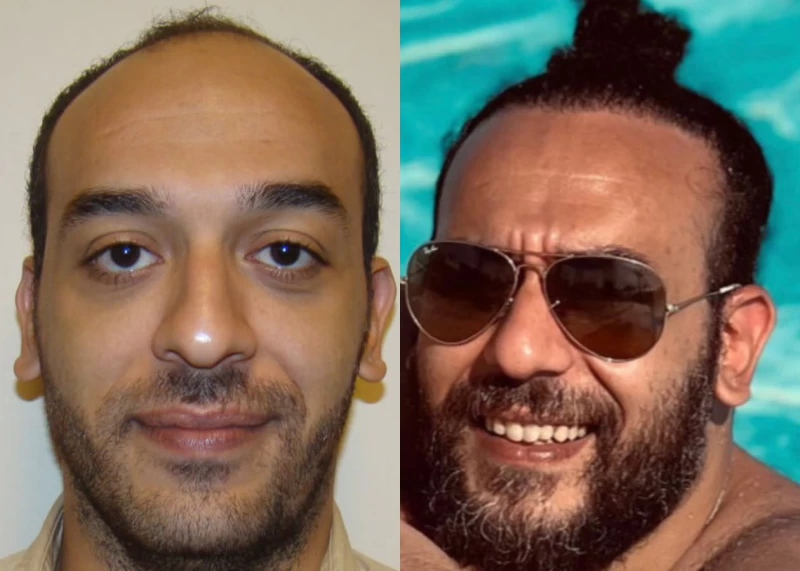 Karim Hair Transplant Before and After