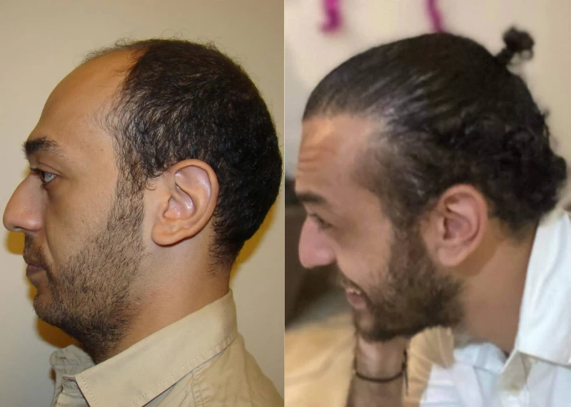 Patient p387 hair transplant before and after left view