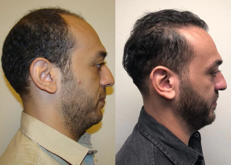 Patient p387 hair transplant before and after right view