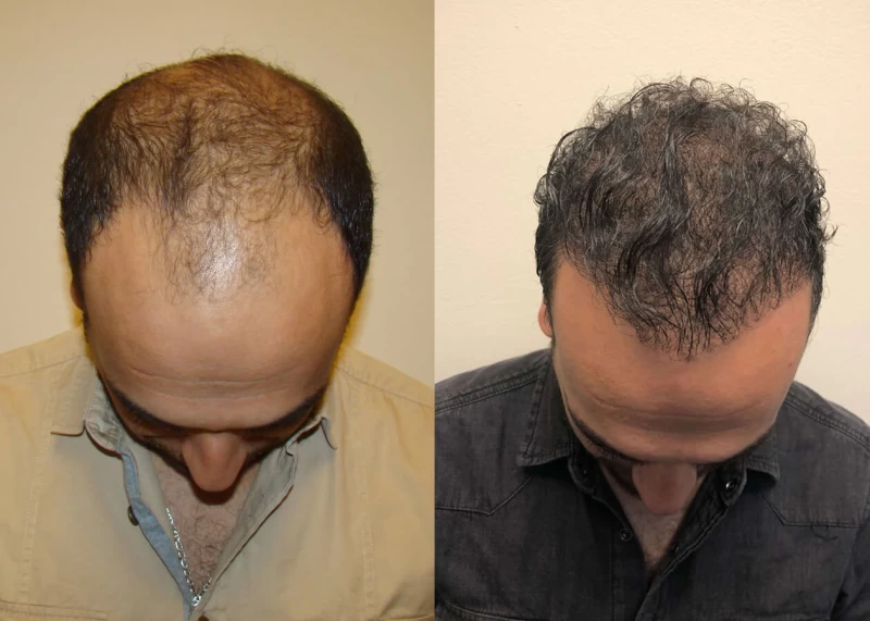 Patient p387 hair transplant before and after tilt view