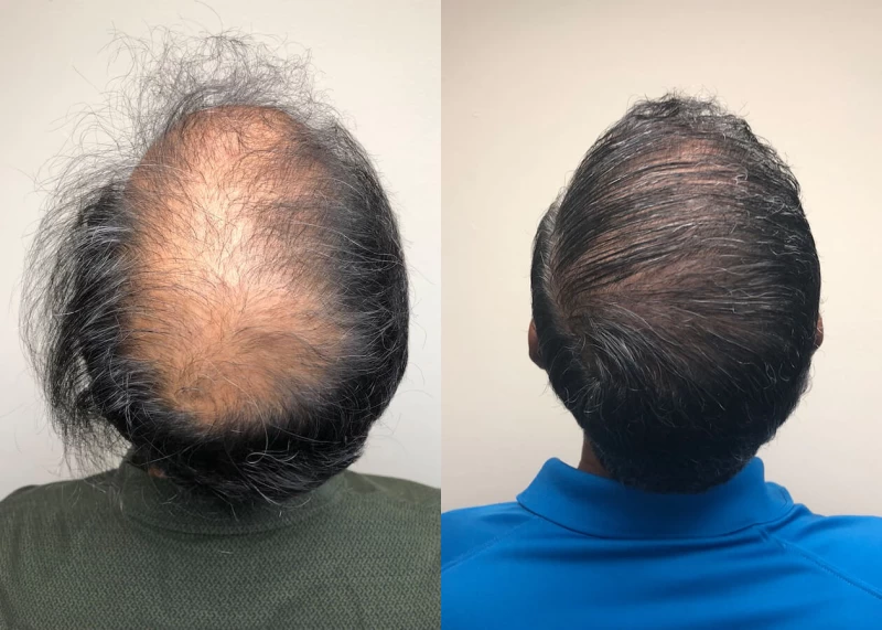 Patient p388 hair transplant before and after crown view