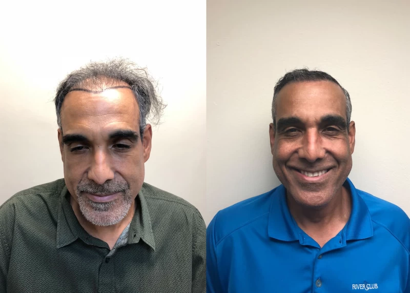 Rolando Hair Transplant Before and After