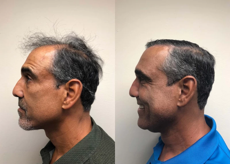 Patient p388 hair transplant before and after left view